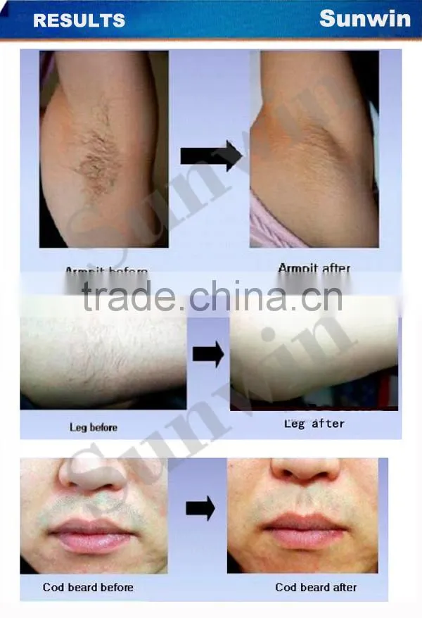Sunwin SW-005E professional laser tattoo removal machine