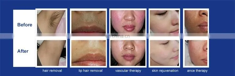 Hot Selling 3 Handles IPL RF/ Nd YAG Laser Tattoo OPT Hair Removal Machine