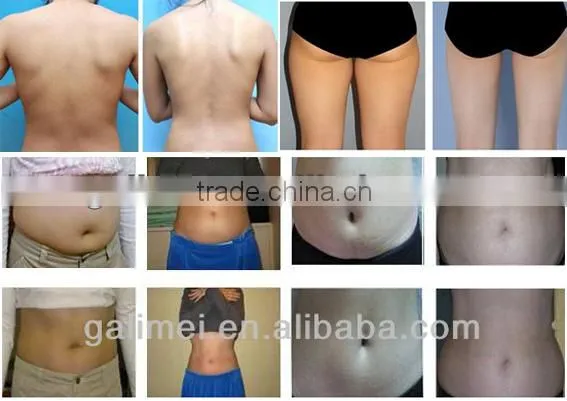 2014 high quality Galimei zetta-iii cavitation/cavitation machine/ultrasonic machine with ce