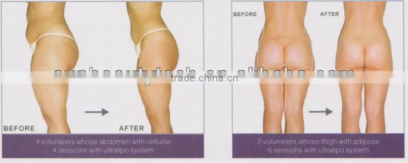 Slimming Machine Ultrasonic Liposuction Equipment