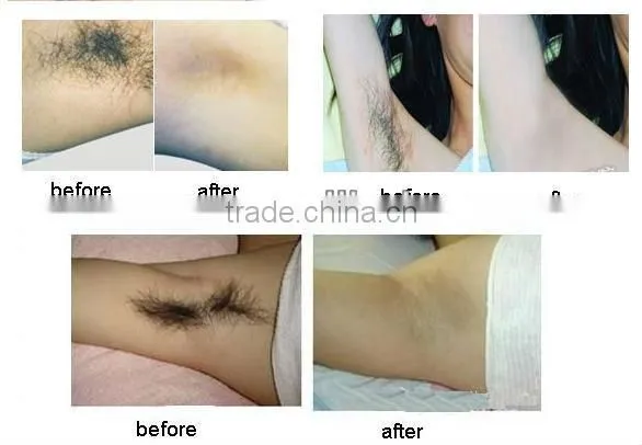 Hair removal 808 diode laser ipl beauty equipment diode laser hair removal machine diode laser device