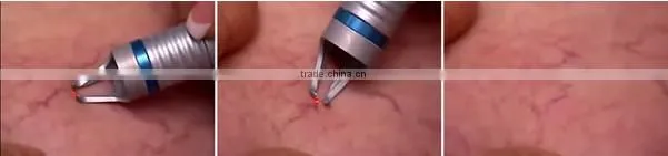 high frequency spider vein/vascular/blood vessels removal machine