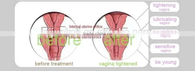 co2 fractional laser vaginal tightening, laser beauty equipment better than vaginal tightening stick