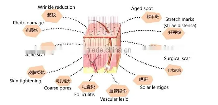 40W Fractional CO2 Laser Acne Scar & Wrinkle Removal / Co2 Laser Surgical Product Vaginal Applicator