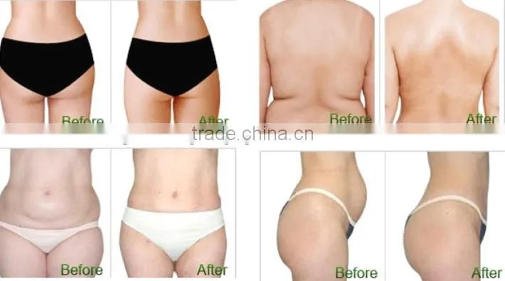 Big promotion ! best slimming product hifu ultrasonic machine price