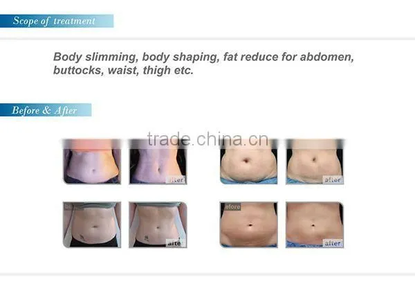 High effective HIFUSHAPE body slimming machine ultra slim cavitation machine