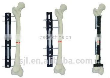 Bone Lengthening External Fixation Frame