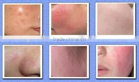 Manufacturer Looking for Distributors Vascualr Removal Machine,Spider Vein Removal