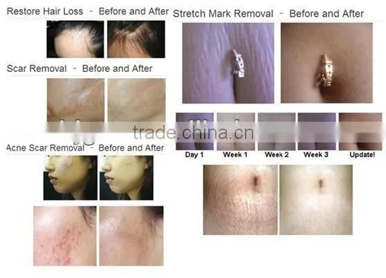 2015 NEW GTO540 Derma roller micro needle roller meso roller skin roller medical CE
