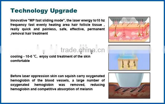 The most popular diode laser 808nm laser of hair removal