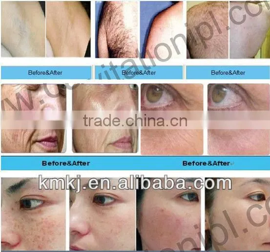 New advanced lumea ipl hair removal system with a big discount!!!