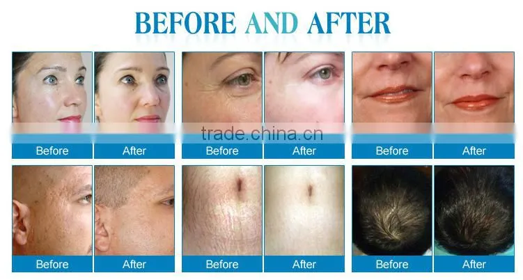 DRS microneedling dermaroller 540 hair loss treatment micro needle roller home use titanium 540 derma roller L015
