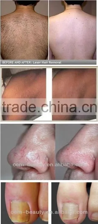 Brand new laser hair removal machine home use with low price