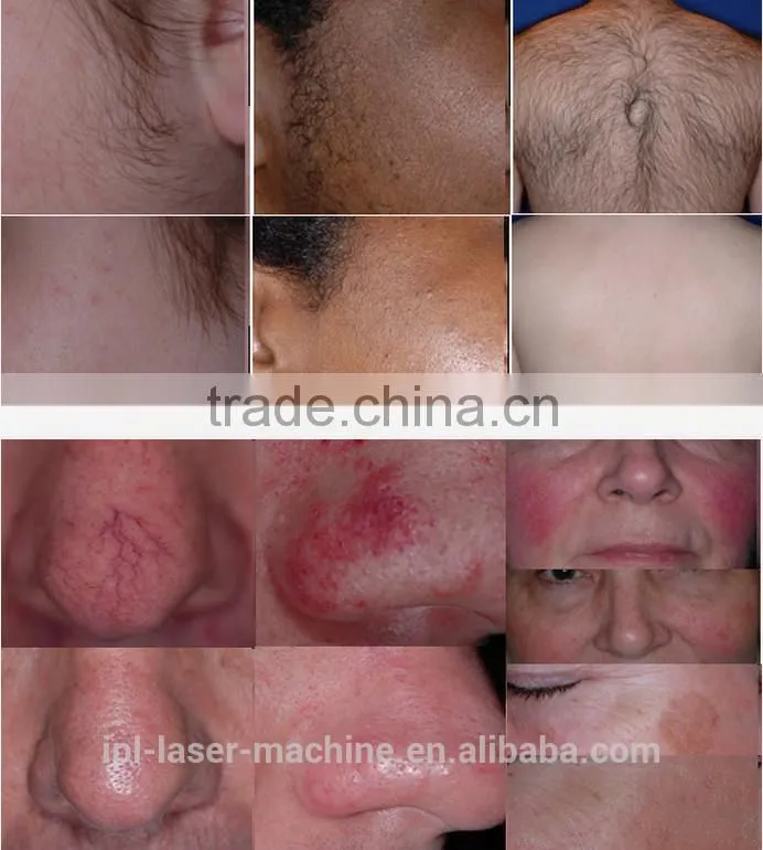 TOP SALES!! NUBWAY new design good quality 3 handles buy ipl hair removal machine ipl