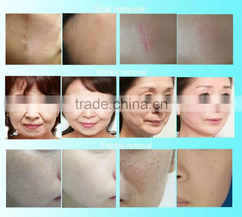2016 medical equipment wrinkle & scar removal co2 fractional laser/ fractional CO2 vaginal removal