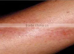 CO2 fractional laser machine for wrinkle removal