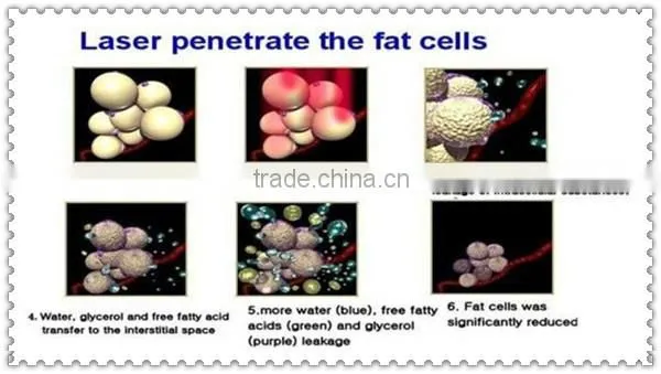Best laser lipolysis machine for weight loss