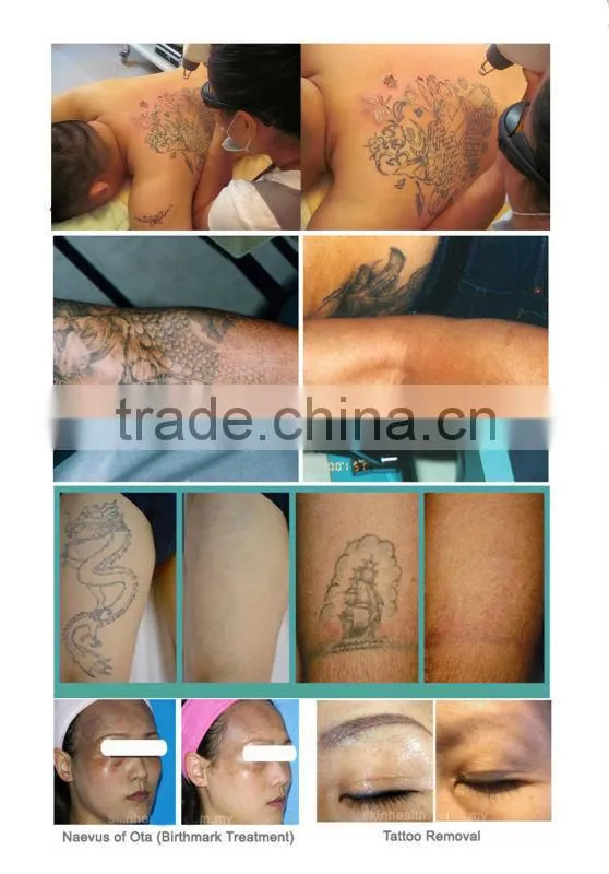 q switch nd yag laser tattoo removal/tattoo laser removal machine