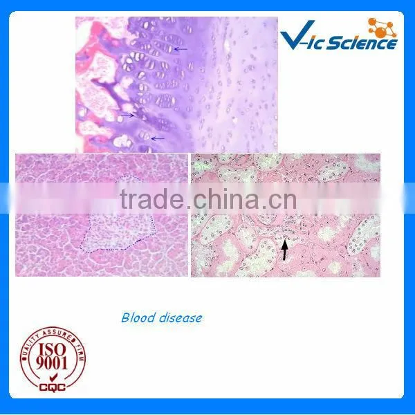 Clinical human blood disease prepared microscope slides