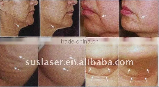 4 Heads portable ultrasonic cavitation+RF (S50B) CE/ISO high frequency curved wood press machine