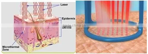 Scar Acne Removal Skin Resurfacing Laser Equipment pixel fractional co2 laser