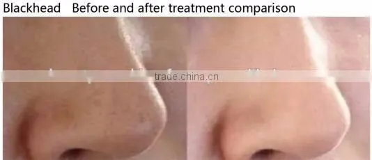 New arrival! microdermabrasion machine face lift at home with radio frequency facial machine