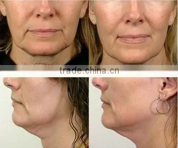 NL-SK9 led pdt bio-light therapy,professional pdt led light therapy equipment for beauty.led pdt