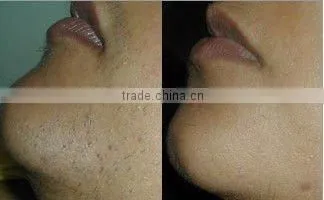 Mobile salon equipment Hair epilator ipl quantum laser A005