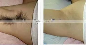 2016 hottest laser hair removal machine 1064nm Laser Hair Removal machine P001