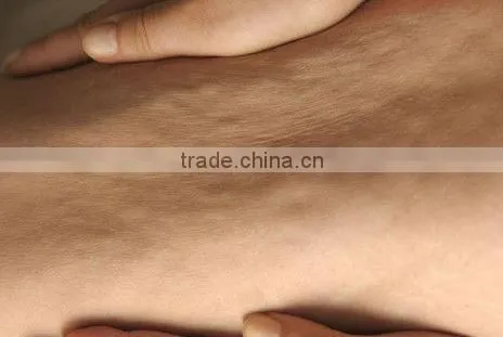 Ultrasonic Liposuction Equipment Weigth Loss Machine