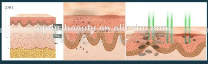 handheld laser hair removal