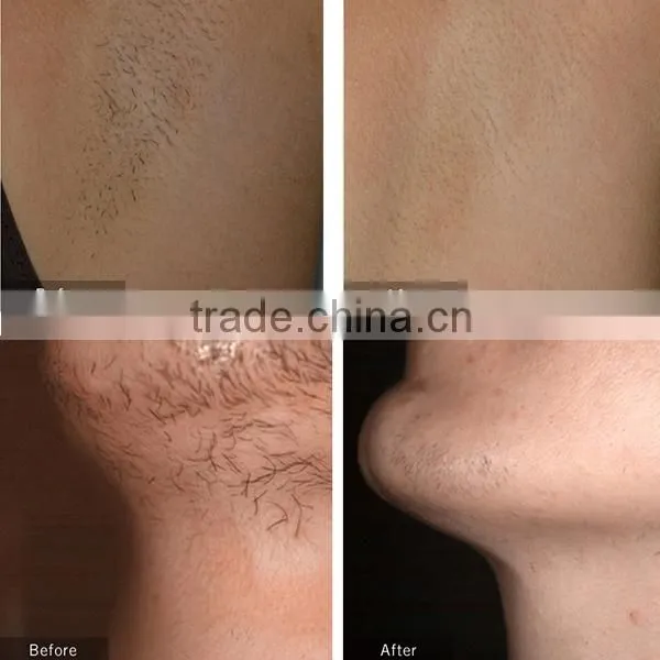 2015 Professional Pain-free 808nm diode laser hair removal machine for sale