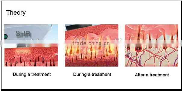 4000W super power SHR tria laser hair removal system