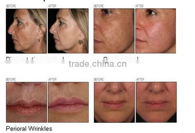 vaginal rejuvenation laser fractional co2 gynecology therapy machine