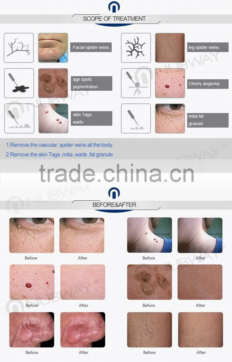Treatment broken capillaries with 30Mhz high frequency