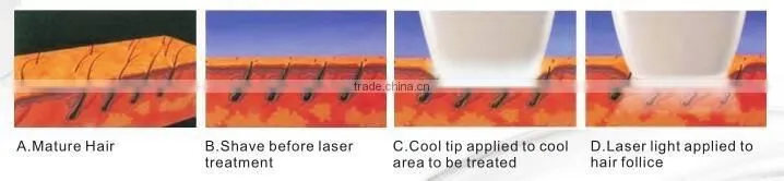 808 diode laser for hair removal with Alex for permanent hair removal