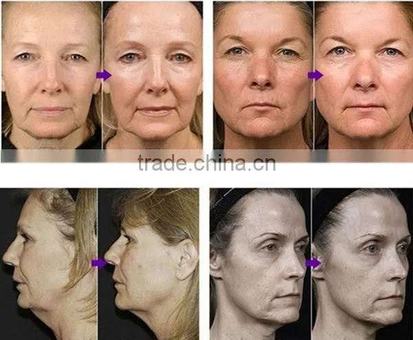 Companies Looking for Distributors Hair Removal Best IPL Machine