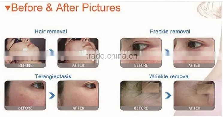 factory price !!! huamei OPT IPL Hair Removal machine/Wrinkle Removal