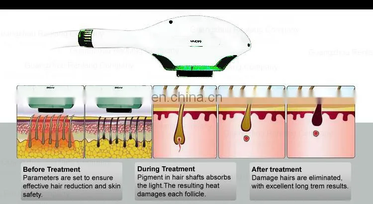 Cheaper Model Ipl Hair Removal Machine for Skin Rejuvenation and Depilation