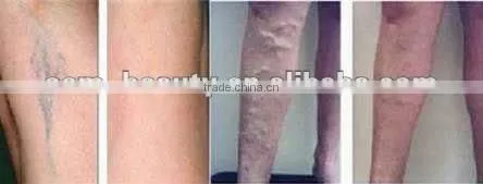 Hot product laser hair removal beauty equipment long pulse
