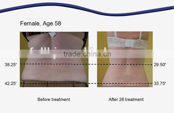 Lipo Laser fat melting machine body slimming machine
