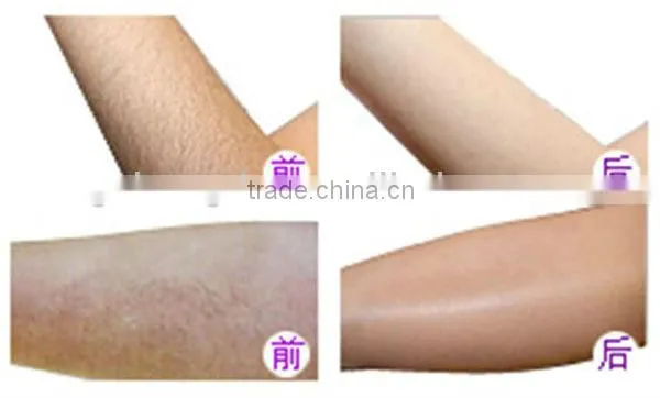 2013 Newest product! permanent lazer home hair removal device for the whole body BD-J005