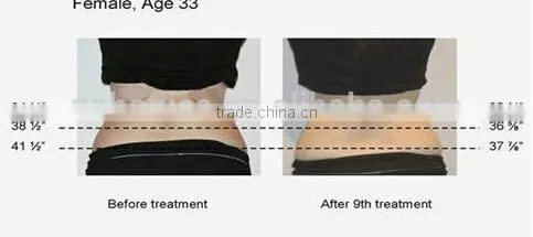 newest!!!criolipolisis freeze fat machine fat freezing beauty machine