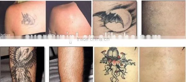 Manufactory Nd yag laser 1064&532nm for tattoo removal and black doll therapy with skin carbon charcola therapy laser deep clean