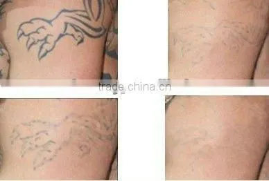 Pro Q Switched nd yag laser tattoo removal machine with 1064nm and 532nm treatment tips