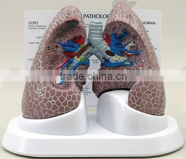 V-AM032 Plastic diseased teaching lung model