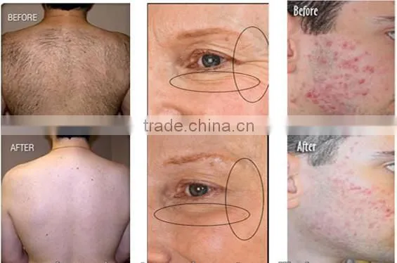 New Design!! Multifunction effective fast hair removal ipl home laser pigmentation