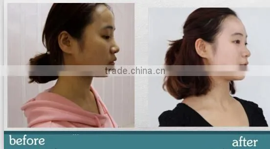 home use hot cakes nd yag laser tattoo removal machine