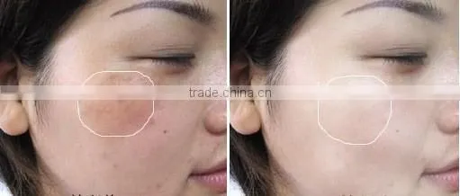 2015 Newest multifunctional cosmetic equipment ipl hair removal germany skin solution