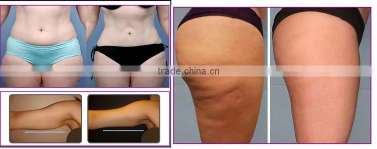 4 in 1 tripolar rf slimming equipment using ultrasound gel OD-S10